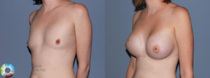 Before & After Breast Augmentation Case 707 View #2 in Denver and Colorado Springs, CO