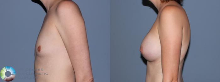 Before & After Breast Augmentation Case 707 View #3 in Denver and Colorado Springs, CO