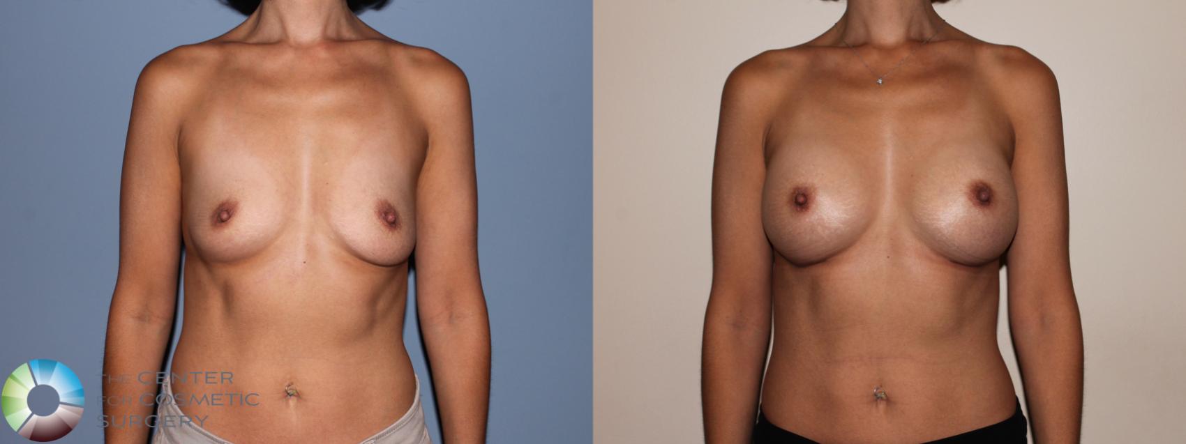 Before & After Breast Augmentation Case 709 View #1 View in Golden, CO