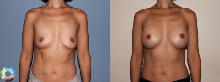 Before & After Breast Augmentation Case 709 View #1 View in Golden, CO