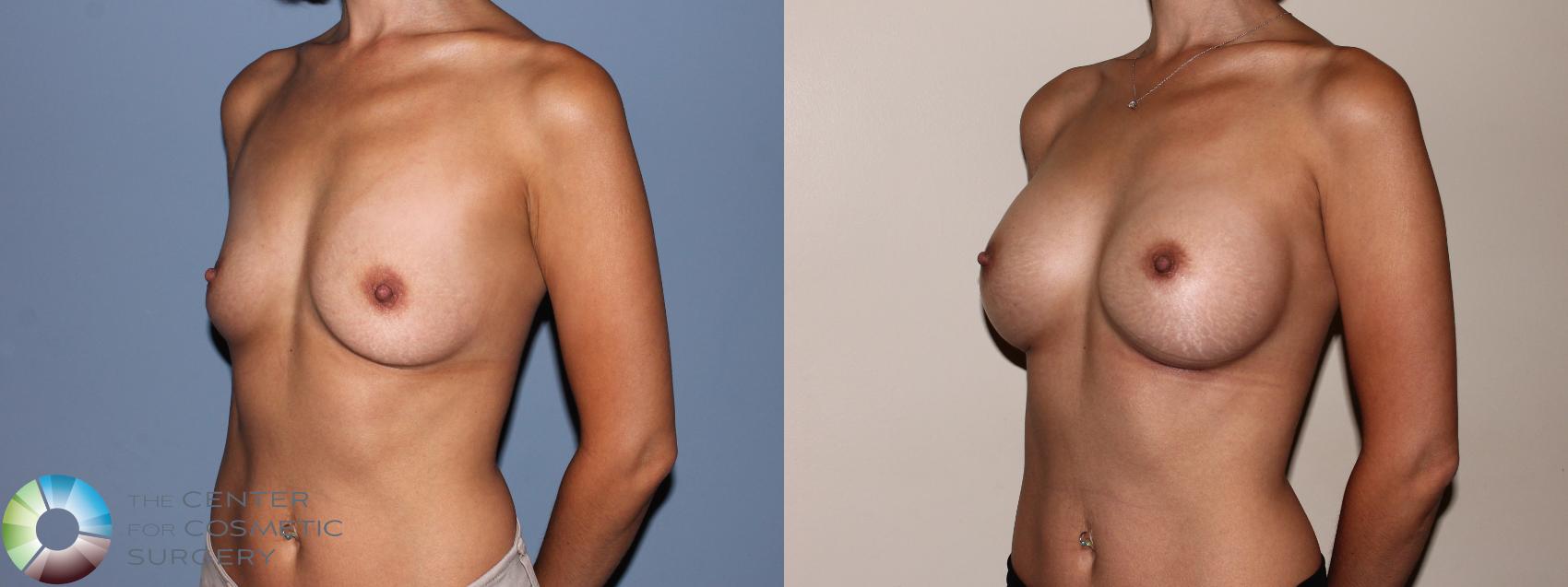 Before & After Breast Augmentation Case 709 View #2 View in Golden, CO