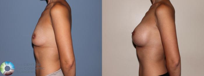 Before & After Breast Augmentation Case 709 View #3 View in Golden, CO