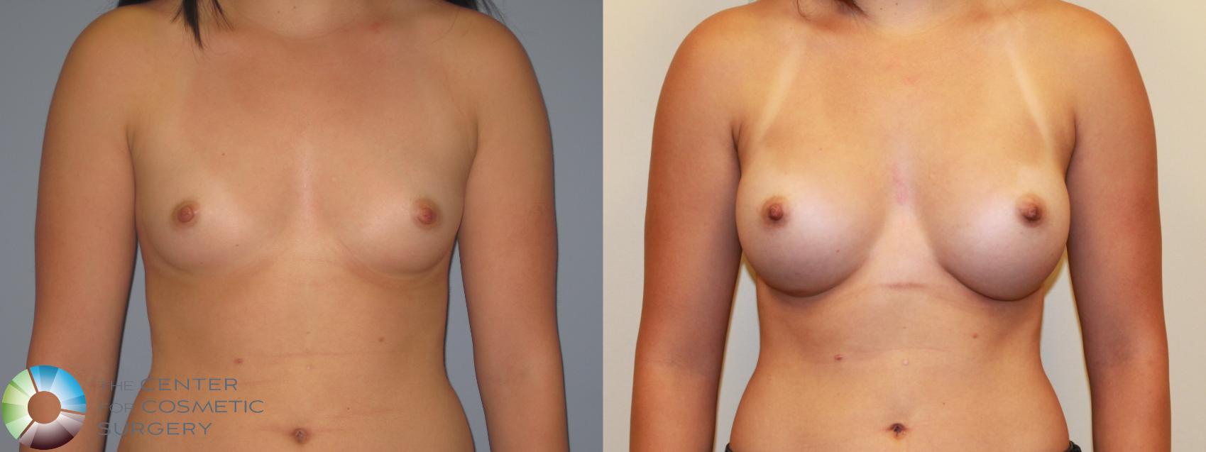 Before & After Breast Augmentation Case 715 View #1 in Denver and Colorado Springs, CO