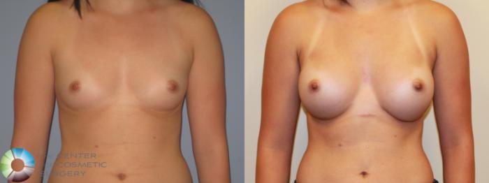 Before & After Breast Augmentation Case 715 View #1 View in Golden, CO