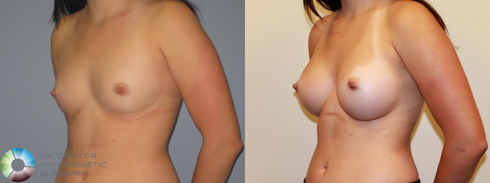 Before & After Breast Augmentation Case 715 View #2 View in Denver & Golden, CO