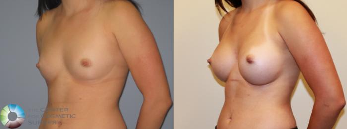 Before & After Breast Augmentation Case 715 View #2 in Denver and Colorado Springs, CO