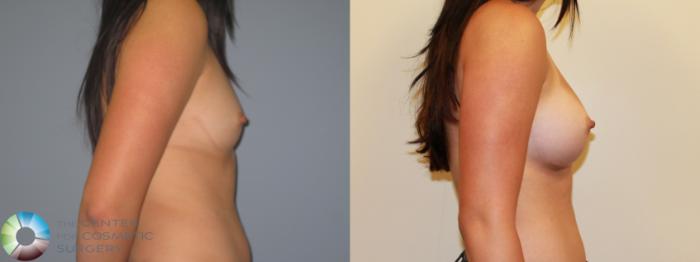 Before & After Breast Augmentation Case 715 View #3 in Denver and Colorado Springs, CO