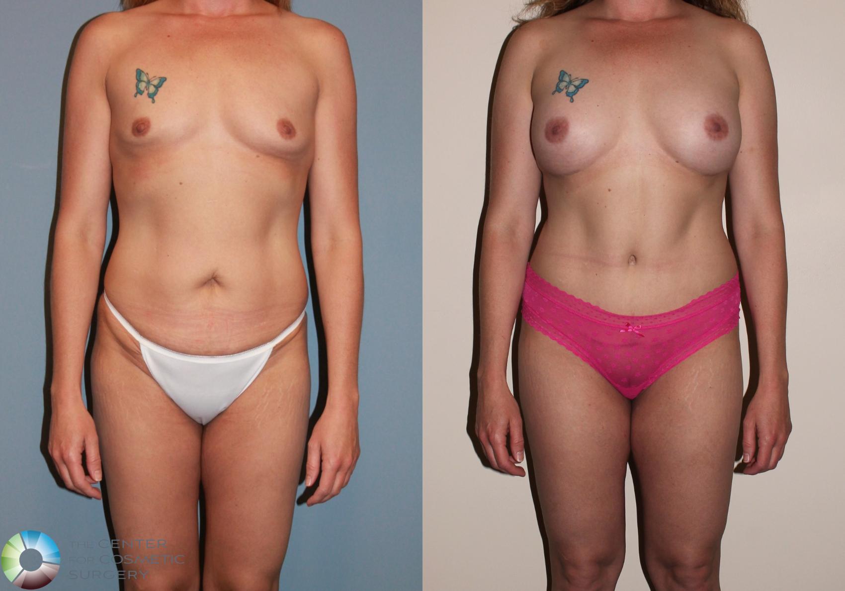 Before & After Breast Augmentation Case 717 View #1 in Denver and Colorado Springs, CO