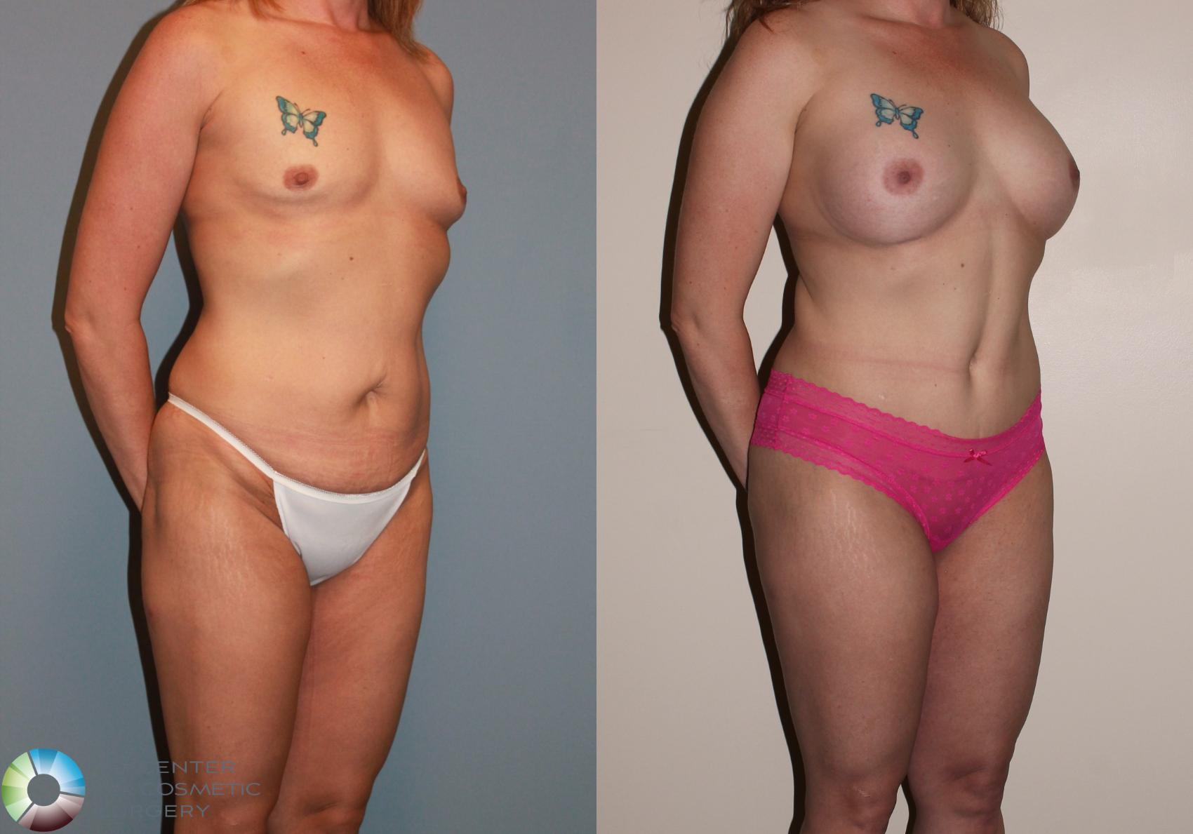 Before & After Breast Augmentation Case 717 View #2 in Denver and Colorado Springs, CO