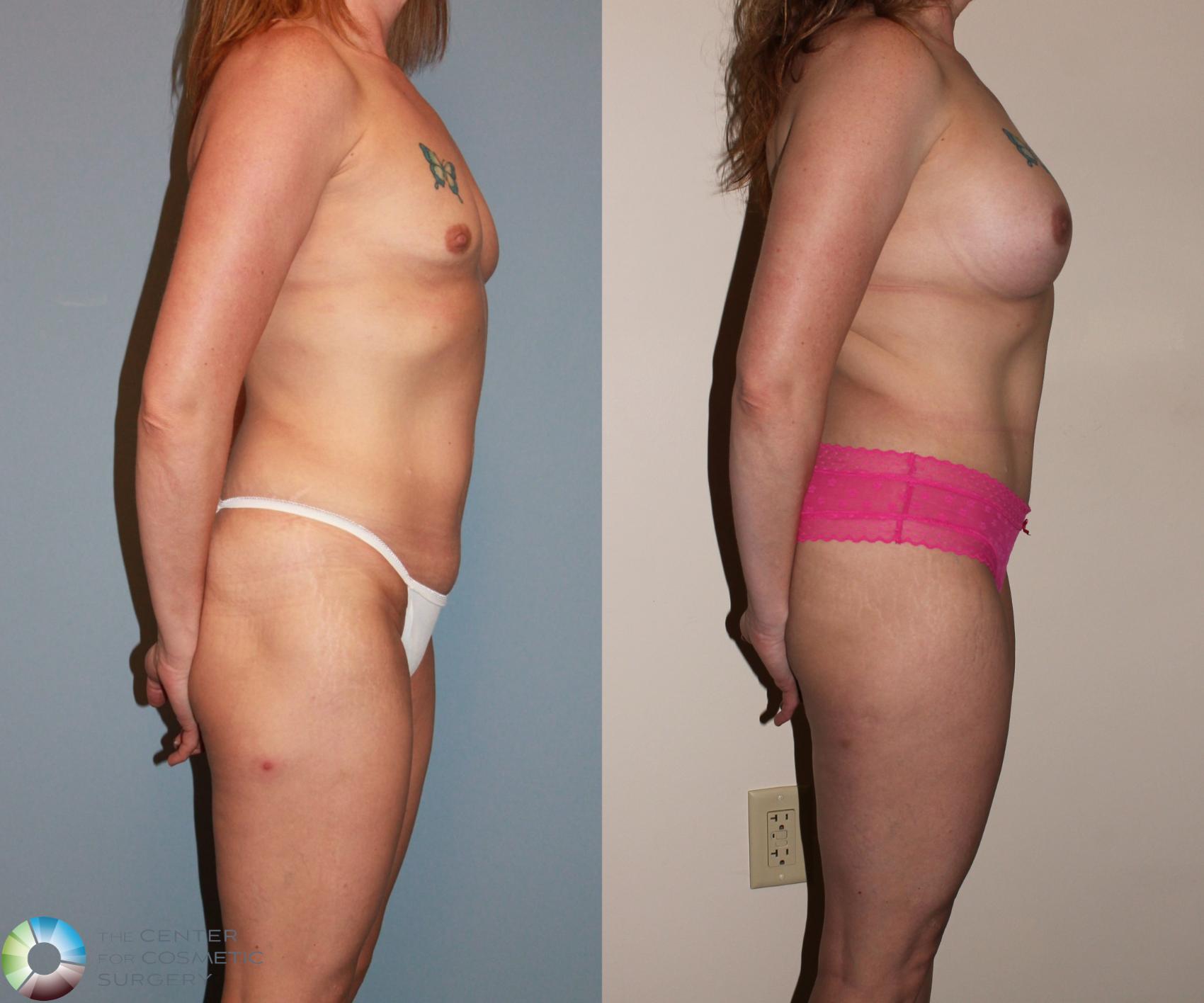 Before & After Breast Augmentation Case 717 View #3 in Denver and Colorado Springs, CO
