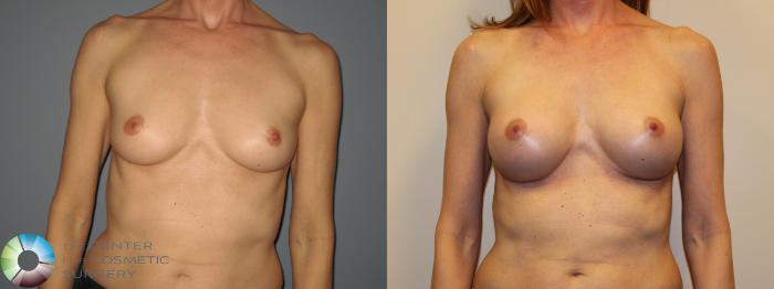 Before & After Breast Augmentation Case 718 View #1 View in Golden, CO