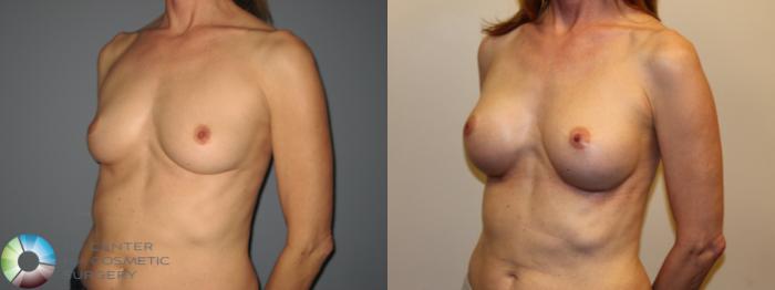 Before & After Breast Augmentation Case 718 View #2 View in Golden, CO