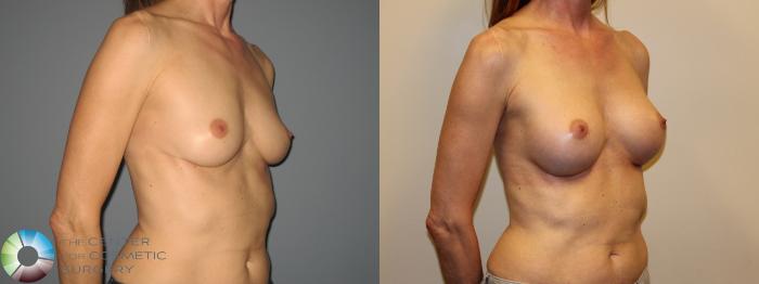 Before & After Breast Augmentation Case 718 View #3 View in Golden, CO