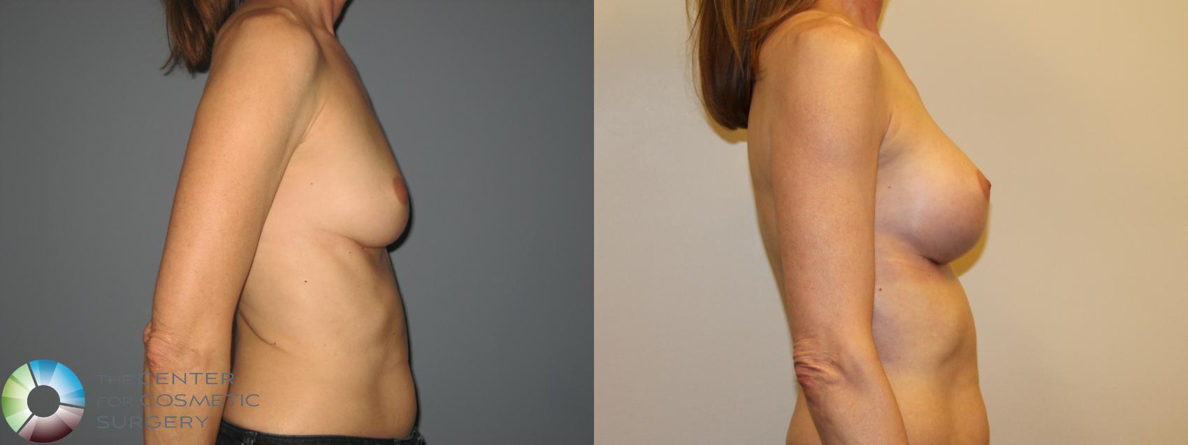 Before & After Breast Augmentation Case 718 View #4 View in Golden, CO