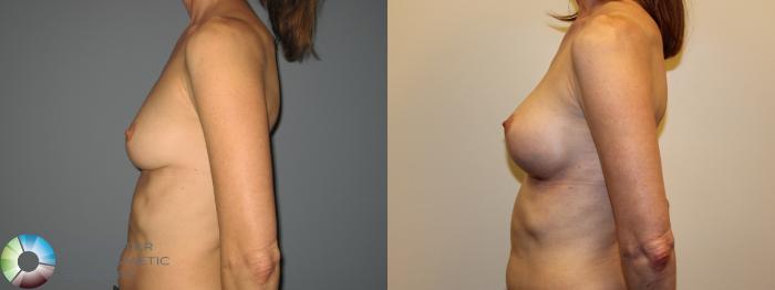 Before & After Breast Augmentation Case 718 View #5 View in Golden, CO