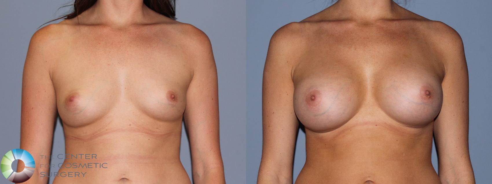 Before & After Breast Augmentation Case 722 View #1 in Denver and Colorado Springs, CO