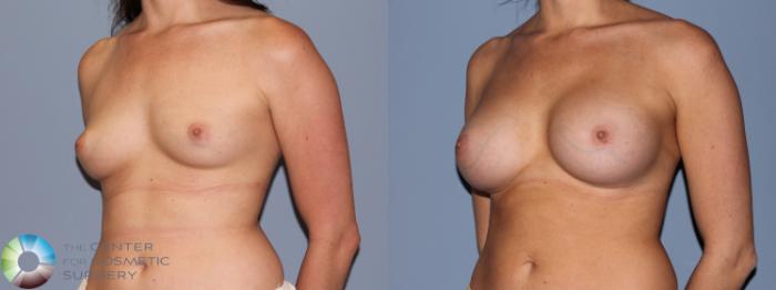 Before & After Breast Augmentation Case 722 View #2 View in Golden, CO