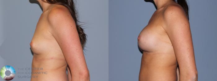 Before & After Breast Augmentation Case 722 View #3 View in Golden, CO