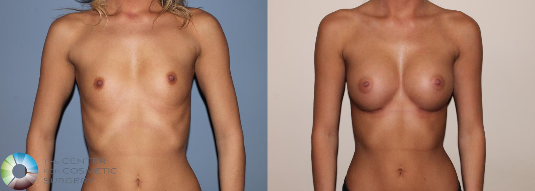 Before & After Breast Augmentation Case 734 View #1 in Denver and Colorado Springs, CO