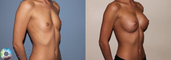 Before & After Breast Augmentation Case 734 View #2 in Denver and Colorado Springs, CO