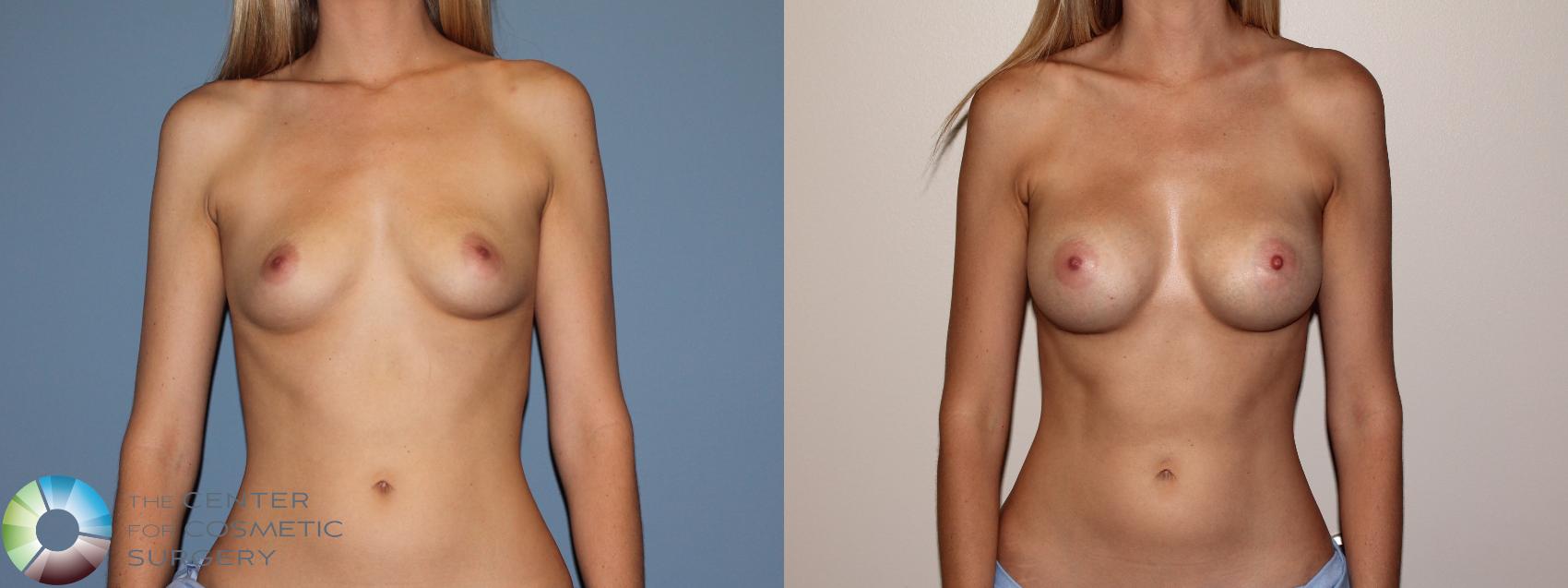 Before & After Breast Augmentation Case 741 View #1 in Denver, CO