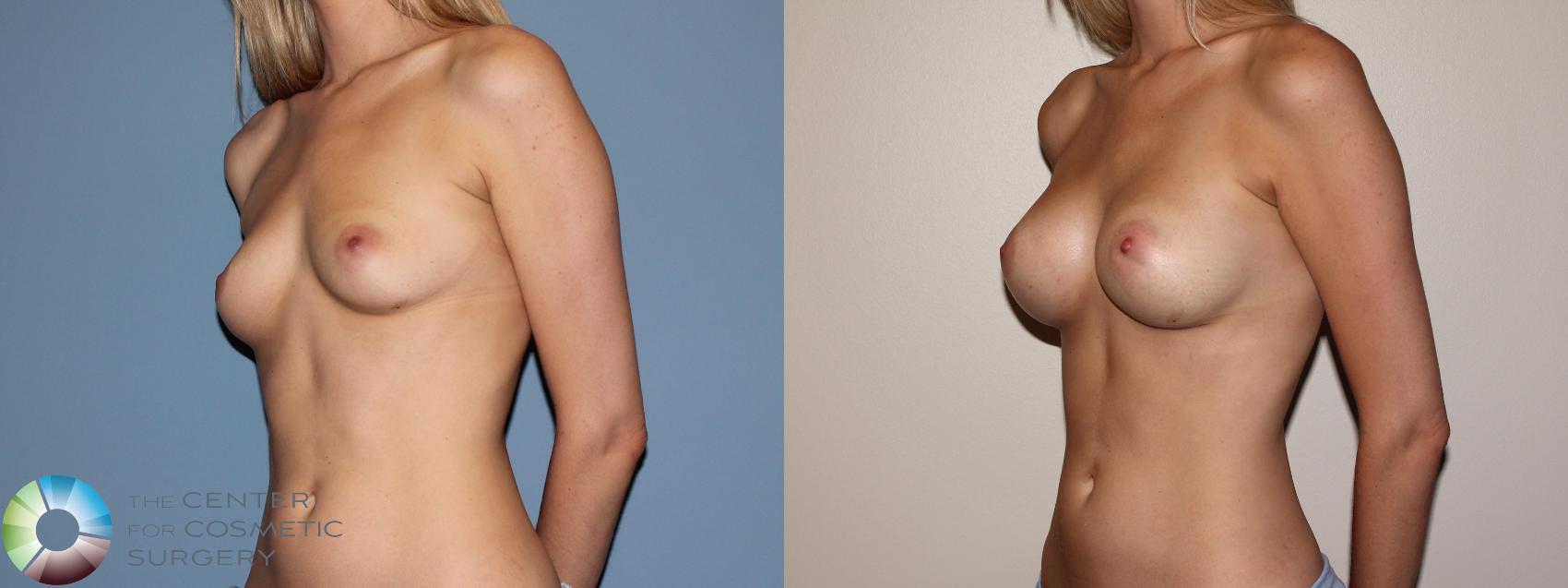 Before & After Breast Augmentation Case 741 View #2 View in Golden, CO