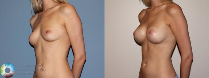 Before & After Breast Augmentation Case 741 View #2 View in Golden, CO