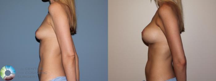 Before & After Breast Augmentation Case 741 View #3 View in Golden, CO