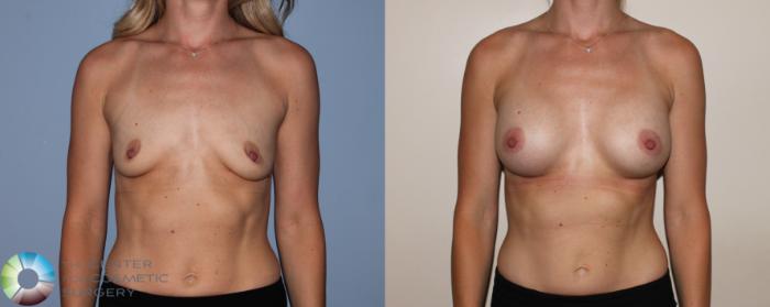 Before & After Breast Augmentation Case 742 View #1 in Denver and Colorado Springs, CO