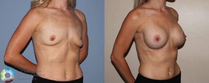 Before & After Breast Augmentation Case 742 View #2 in Denver and Colorado Springs, CO