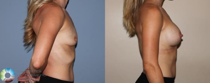 Before & After Breast Augmentation Case 742 View #3 in Denver and Colorado Springs, CO