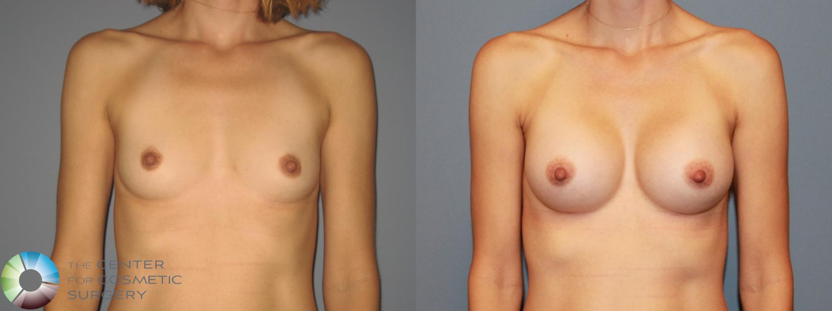 Before & After Breast Augmentation Case 749 View #1 in Denver and Colorado Springs, CO