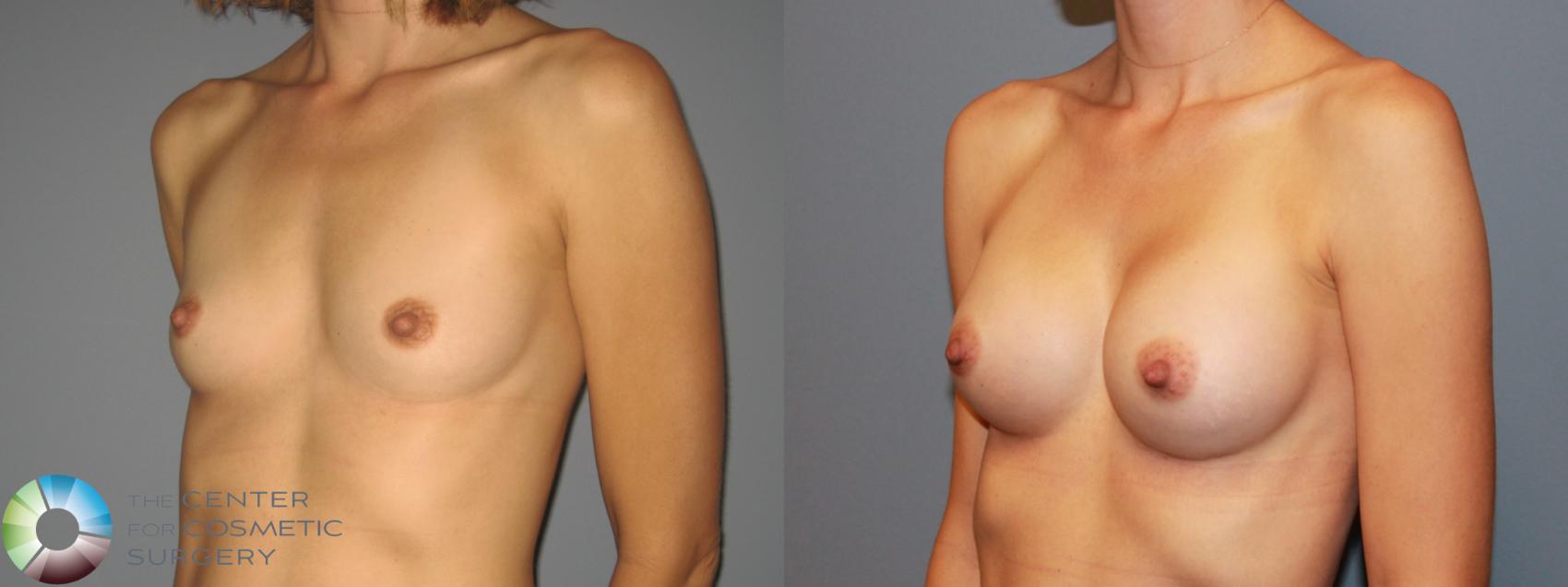 Before & After Breast Augmentation Case 749 View #2 in Denver and Colorado Springs, CO