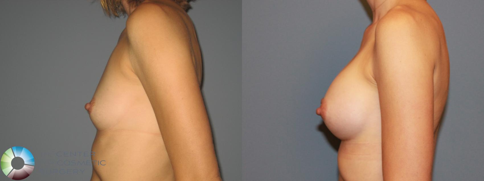 Before & After Breast Augmentation Case 749 View #3 in Denver and Colorado Springs, CO