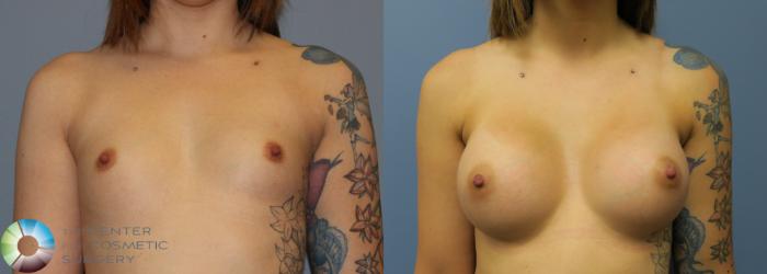 Before & After Breast Augmentation Case 753 View #1 in Denver and Colorado Springs, CO