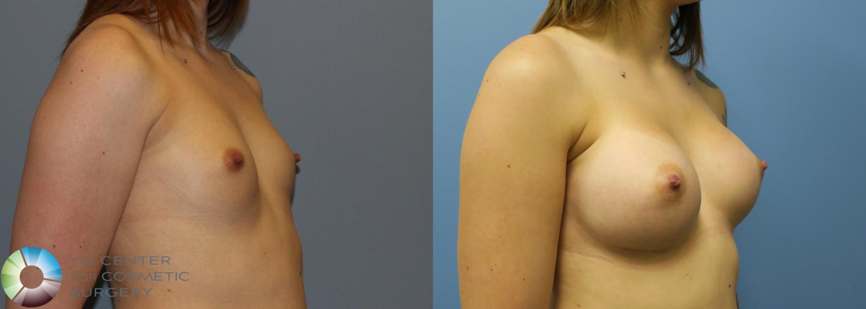 Before & After Breast Augmentation Case 753 View #2 View in Golden, CO