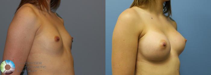Before & After Breast Augmentation Case 753 View #2 in Denver and Colorado Springs, CO