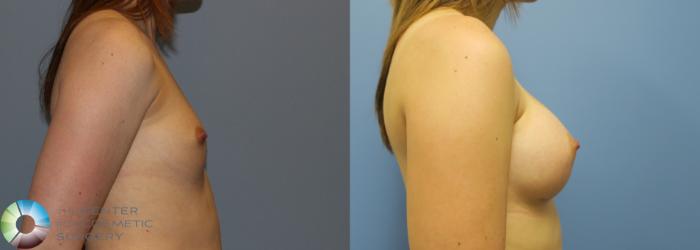 Before & After Breast Augmentation Case 753 View #3 in Denver and Colorado Springs, CO