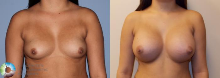 Before & After Breast Augmentation Case 754 View #1 in Denver and Colorado Springs, CO