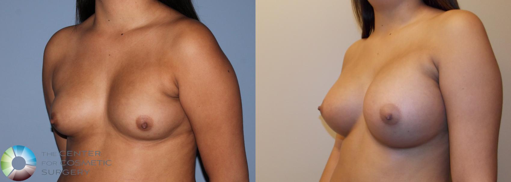 Before & After Breast Augmentation Case 754 View #2 in Denver and Colorado Springs, CO