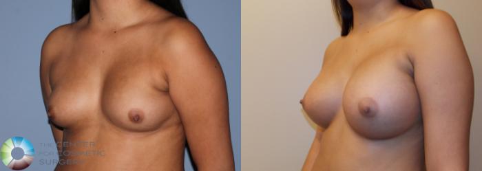 Before & After Breast Augmentation Case 754 View #2 in Denver and Colorado Springs, CO