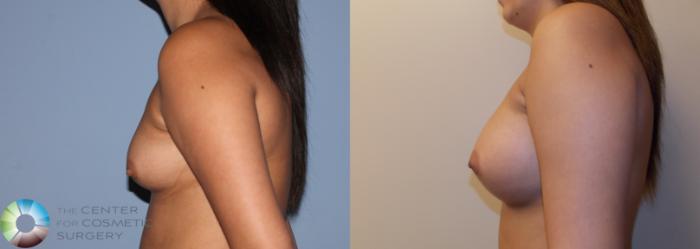 Before & After Breast Augmentation Case 754 View #3 in Denver and Colorado Springs, CO
