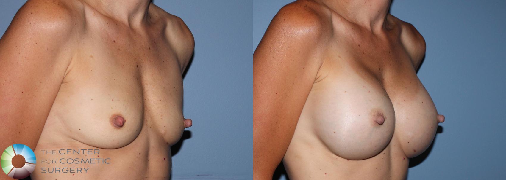 Before & After Breast Augmentation Case 755 View #1 in Denver, CO