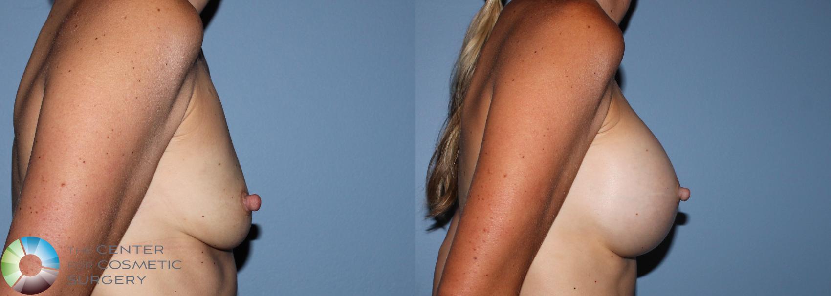 Before & After Breast Augmentation Case 755 View #2 View in Golden, CO
