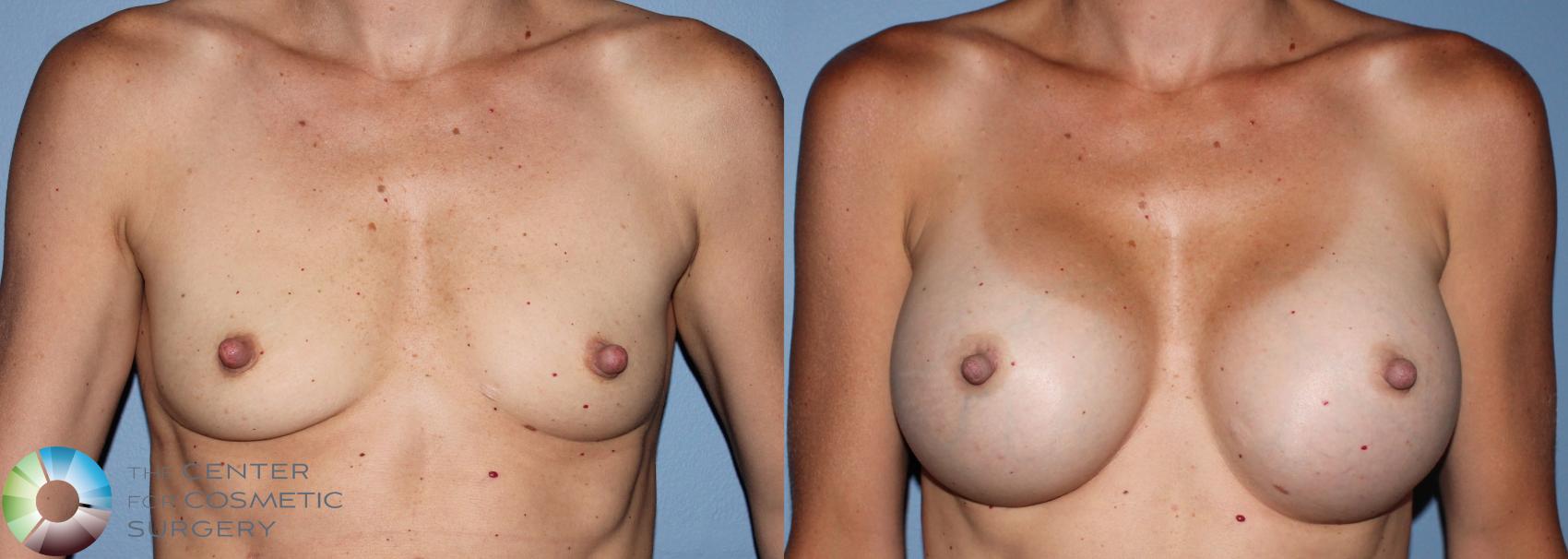 Before & After Breast Augmentation Case 755 View #3 View in Golden, CO