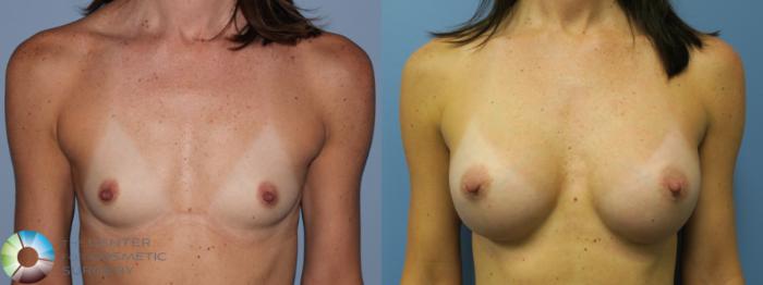 Before & After Breast Augmentation Case 756 Front in Denver and Colorado Springs, CO