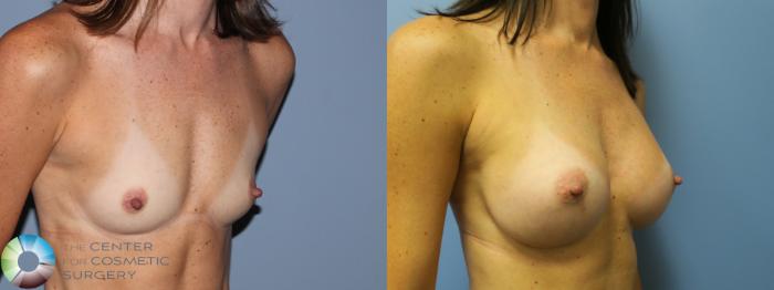 Before & After Breast Augmentation Case 756 Right Angle in Denver and Colorado Springs, CO