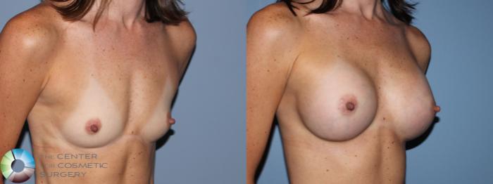 Before & After Breast Augmentation Case 756 Right Oblique in Denver and Colorado Springs, CO