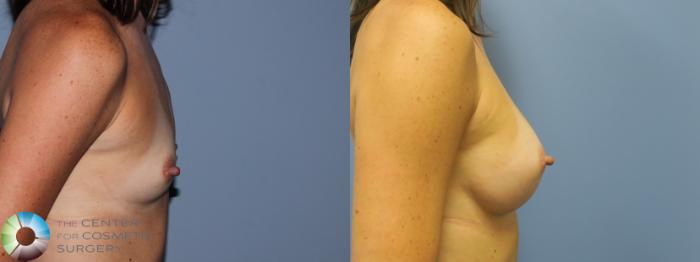Before & After Breast Augmentation Case 756 Right Side in Denver and Colorado Springs, CO