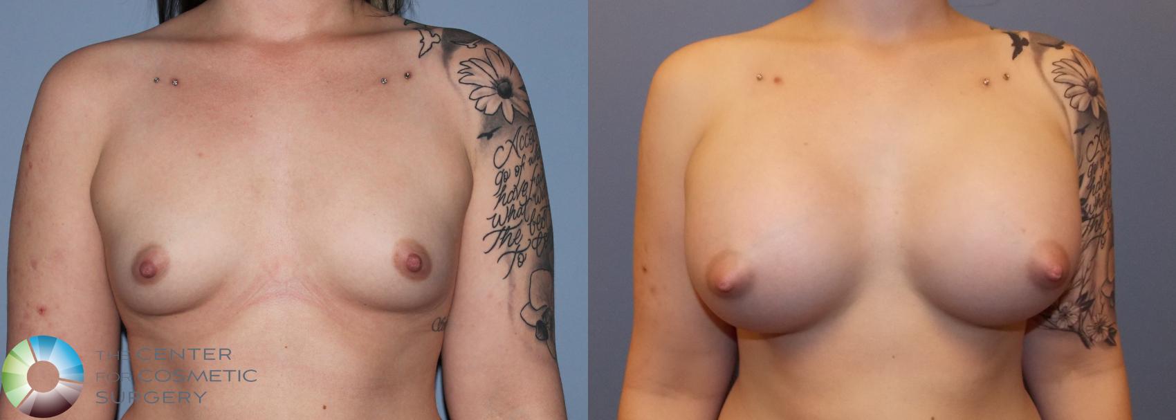 Before & After Breast Augmentation Case 757 View #1 in Denver and Colorado Springs, CO